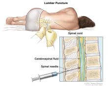 lumbar puncture