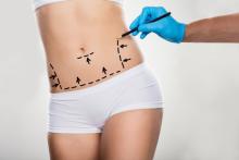 liposuction