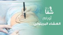 liposuction