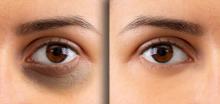 Dark Circle Reduction Treatment Ghaziabad