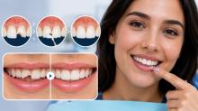 Teeth Grinding Treatment (Bruxism) Gurgaon | Dr. Gupta's Shri Ram Dental Care