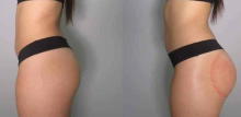 vacuum butt lift before and after