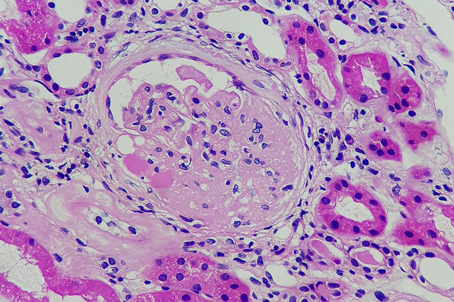 Focal Segmental Glomerulosclerosis Causes