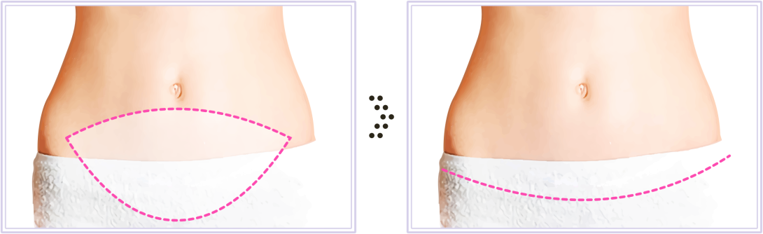 tummy tuck