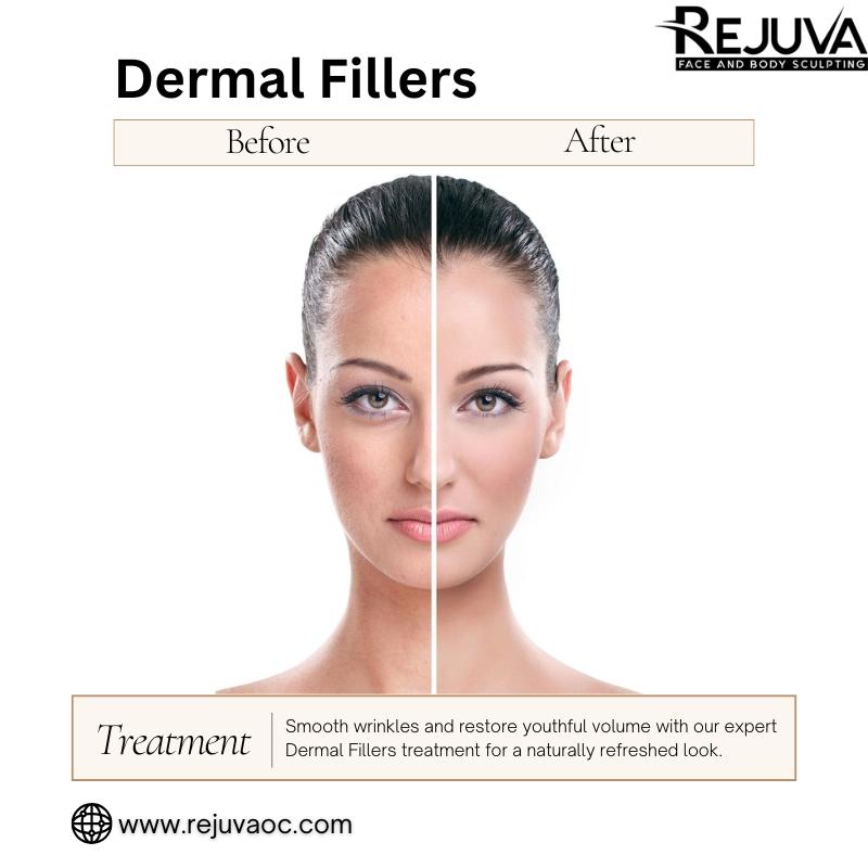 Dermal Fillers Newport Beach