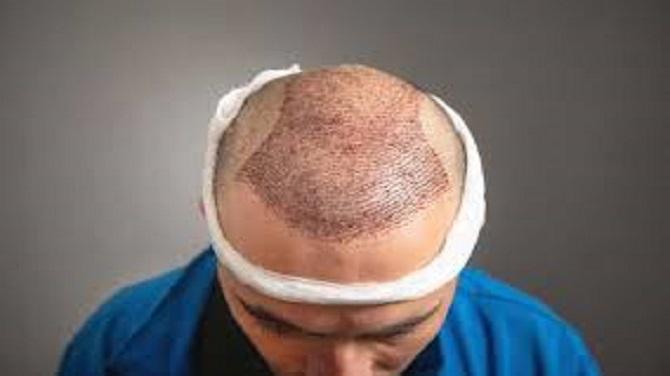 زراعة الشعر في الرياض
