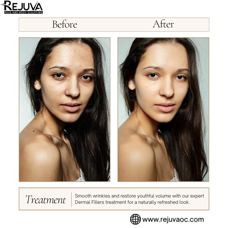 Dermal Fillers in Newport Beach Treatments