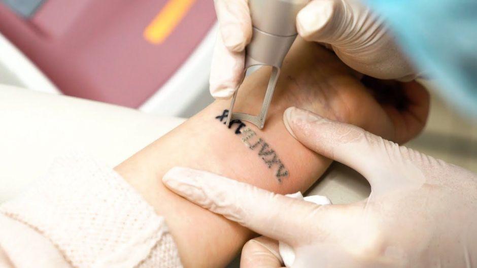 Tattoo Removal in Dubai
