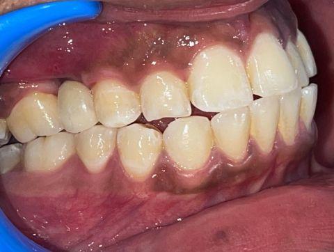 dental implant at white star