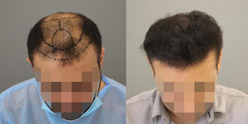 Hair Transplant in Abu Dhabi