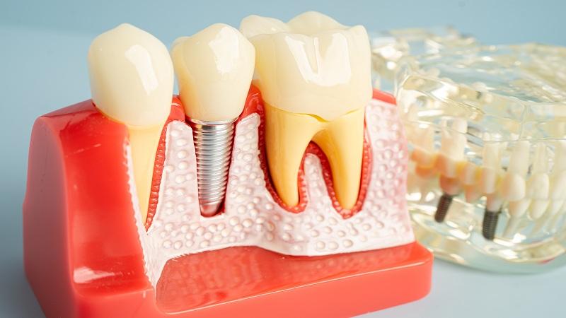 Dental Implant Care at Willow Street Dental