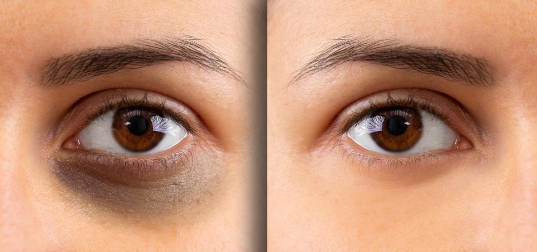 Dark Circle Reduction Treatment Ghaziabad