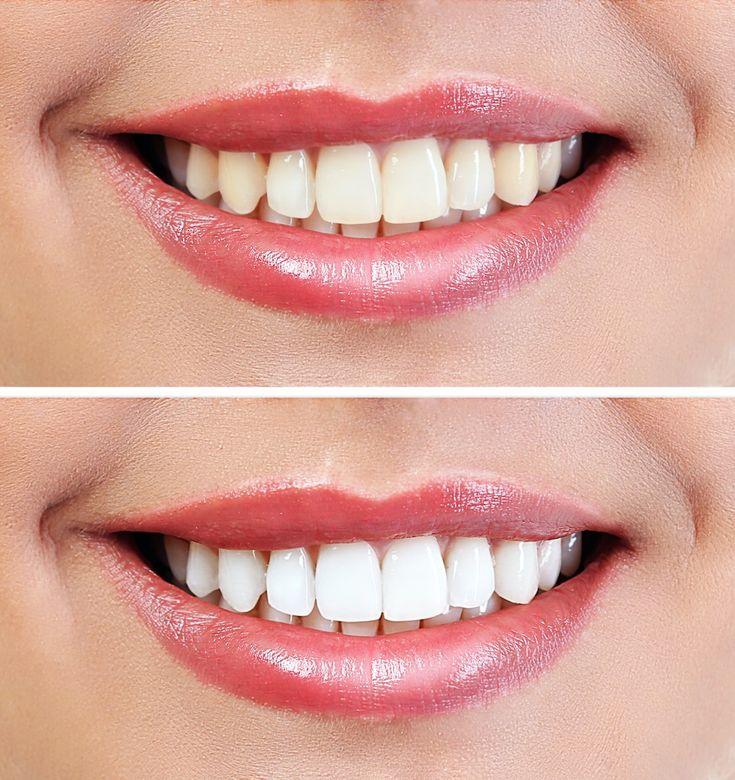wisdom teeth removal mississauga procedure at revive dental clinic