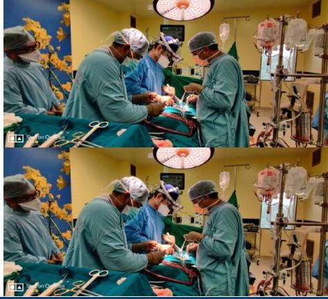 AV Fistula Symptoms