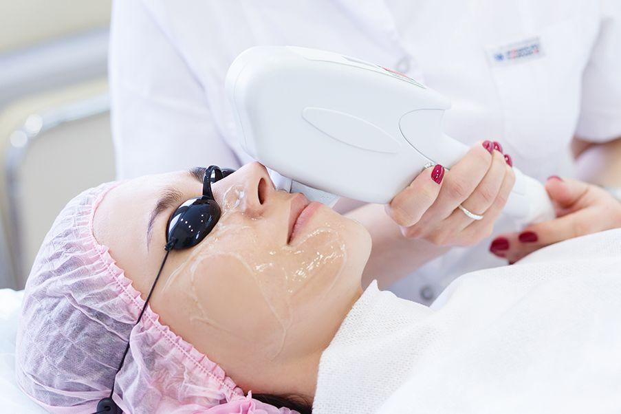 laser facial Delhi